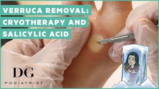 Verruca removal cryotherapy and salicylic acid [upl. by Spear]