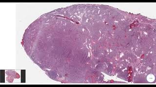 Carney Complex v Carney Triad v CarneyStratakis Syndrome pathagonia [upl. by Yrrap]