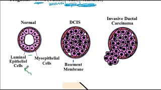 USMLE ACE Video 261 Breast Pathologies  Common Benign Disorders and Malignant Tumors [upl. by Ninnette]