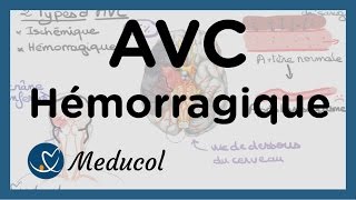 AVC Hémorragique et hémorragie cérébrale hémorragie cerveau [upl. by Notnilc]