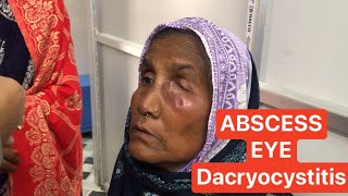 Abscess formation  Dacryocystitis  eye [upl. by Haimehen]