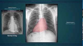 Situs Inversus with Dextrocardia Explanation of Chest Xray Findings [upl. by Htidirrem]