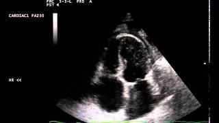 constrictive pericarditis septal bounce [upl. by Arihsat]