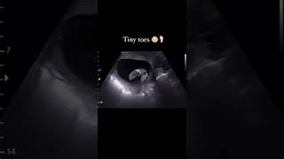 Ultrasound scan In Pregnancy [upl. by Nyltyak]