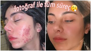 Fotoğraflı Roaccutane Sürecim🥵🧖🏻‍♀️ Sivilce Tedavisi✨ [upl. by God]