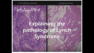 Explaining the pathology of Lynch Syndrome [upl. by Stew]