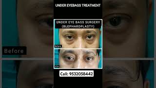 Undereyebags treatment puffyeyes darkcircles skincare eyebags prp fillers fatgrafting peel [upl. by Deehahs652]