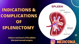 SPLENECTOMY  Indications amp Complications of splenectomy  surgery of spleen [upl. by Tootsie]