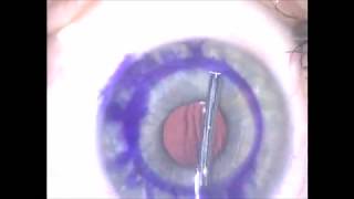 DSEK Eye Surgery for Fuchs Dystrophy [upl. by Ruhtracam789]