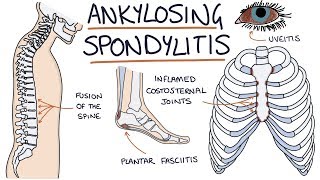 Ankylosing Spondylitis Visual Explanation for Students [upl. by Yahsan]