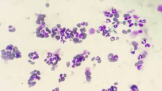 Neutrophilic Leukocytosis Blood smear examination [upl. by Kreindler]