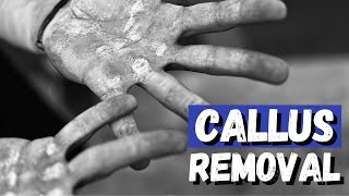 Hand Callus Removal  Get Rid of that Hard and Rough Skin [upl. by Eat]