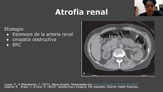 Hipoplasia renal  Malformaciones renales [upl. by Tterag]