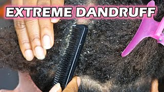 How to remove Dandruff From Natural Hair  DiscoveringNatural [upl. by Nnylaehs]