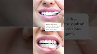 Enlighten  Teeth Whitening Process  London  Whites Dental [upl. by Ellennahc]