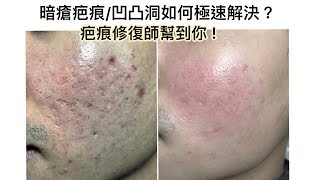 個案927🆘暗瘡疤痕•凹凸洞如何極速解決？疤痕修復師幫到你 JampG Beauty [upl. by Eerahc]