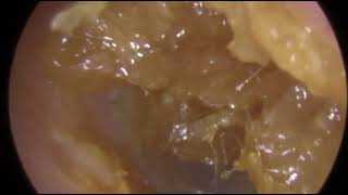 Ear Wax Removal of Impacted Blocked Ear Wax  Ep 298 [upl. by Pansir]