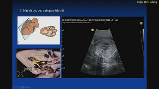 Chẩn đoán bệnh TBS trước sinh bằng siêu âm tim thai  ThS BS Thái Việt Tuấn [upl. by Lena]
