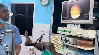 Kidney stent removal DRMLAKSHMI RAMESH MS UROLOGY NELLORE [upl. by Christis]