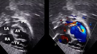 Modified Echo Views quot Ductal amp Fallot views quot [upl. by Edrahs]