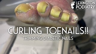 Curling Toenails Trimming Diabetic Nails [upl. by Goodyear]