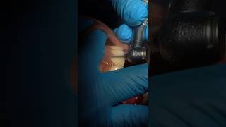 Precision Veneer Prep ASMR teeth dentalcrowns prep [upl. by Fernande384]