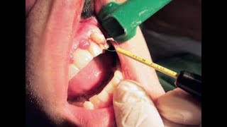 Gingivectomy hf surg [upl. by Yesac516]