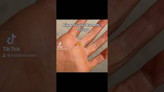 Ripped Callus Remedy ripped callustreatment callus hand remedy workout workhands cringe [upl. by Aitnas]