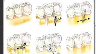 Resective Osseous Surgery [upl. by Nyladnar352]