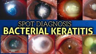 Bacterial keratitis  clinical features [upl. by Zitella]