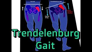 Trendelenburg Gait Explained and How to Fix [upl. by Chon]