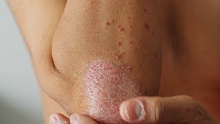 What Is Plaque Psoriasis [upl. by Nofets]