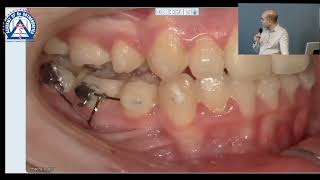 Monday Tip Uprighting Ectopic Molars [upl. by Brear]