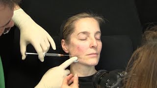 Liquid Facelift – Video Unterspritzung mit Hyaluronsäure – Zeitraffer Facelift ohne OP [upl. by Lemmie950]