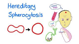 Hereditary Spherocytosis HS  Red Blood Cell Disorders  Hematology [upl. by Attelrahc]