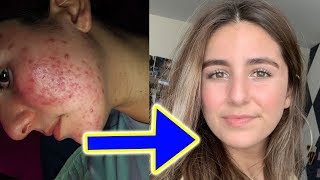 6 MONTH ACCUTANE TRANSFORMATION TIMELINE  Gaining back my confidence   Accutane 2 [upl. by Cori]