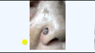 BASAL CELL CARCINOMA DR SAMEH GHAZY [upl. by Lehpar]