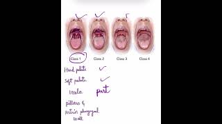 Modified Mallampati classification Anaesthesia [upl. by Latea655]