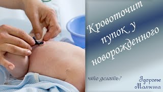 Что делать если кровоточит пупок у новорожденного [upl. by Idurt]