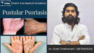 Pustular psoriasis  Psoriasis  Skin Disease  Skin psoriasis psoriasiscure psoriasissolution [upl. by Arie]