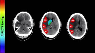 Perfusion Imaging Part 1  Free Radiology CME [upl. by Tnecnev79]