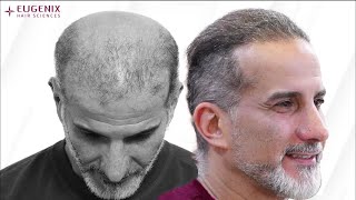 A lifechanging hair transplant at Eugenix uses 3566 grafts [upl. by Glynnis705]