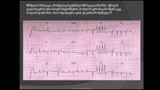 მოციმციმე არითმია წინაგულების ფიბრილაცია პარკუჭოვანი ექსტრასისტოლები და პარკუჭოვანი ტაქიკარდია [upl. by Evadnee477]