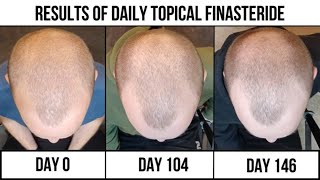 Homemade Topical Finasteride Results 5 months [upl. by Rebeh]