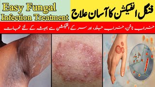 Fungal Infection Ka Asan Ilaj  Easy Fungal Infection Treatment  خراب ناخن کا علاج DrKashif Bilal [upl. by Marteena710]