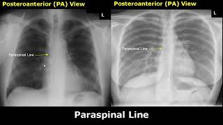 Normal Chest XRay Labelled Anatomy PA View Part 2 CXR Interpretation  Mediastinum Radiography [upl. by Eilloh557]