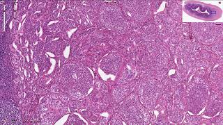 Neuroendocrine Tumor  Appendix  Histopathology [upl. by Nanyt]