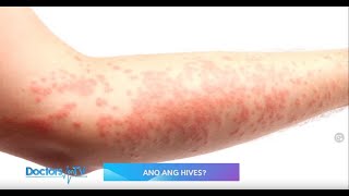 HIVES Symptoms and Treatment [upl. by Mcgruter138]