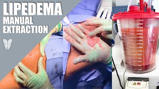 LIVE from Behind the Scenes in the OR  Total Lipedema Care [upl. by Yttocs430]