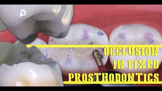 Occlusion in Fixed Prosthodontics [upl. by Saenihp]